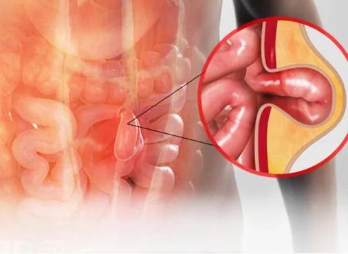 Recurrent Hernia consultation at Niraaya Hospital